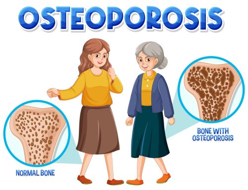 La osteoporosis puede dificultar la colocación de prótesis e implantes por la pérdida de fuerza del hueso