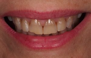 Sin carillas de porcelana.