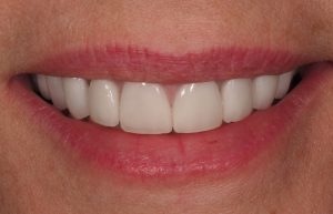 Con carillas de porcelana.